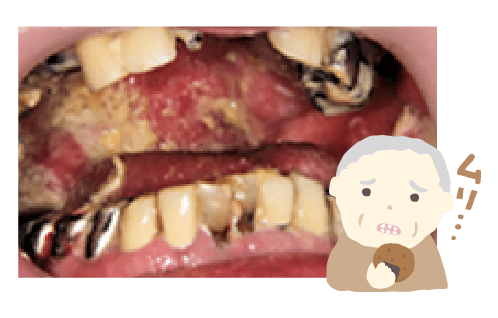 口腔ケアを怠り、汚れが溜まってしまった歯